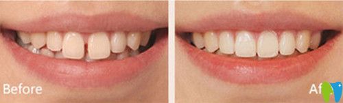 美奧口腔好不好？看杭州美奧瓷貼面變化圖