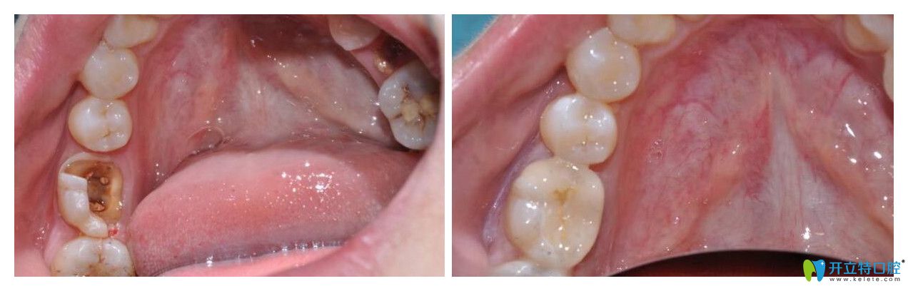 曹雪后牙瓷?？绦迯?fù)案例