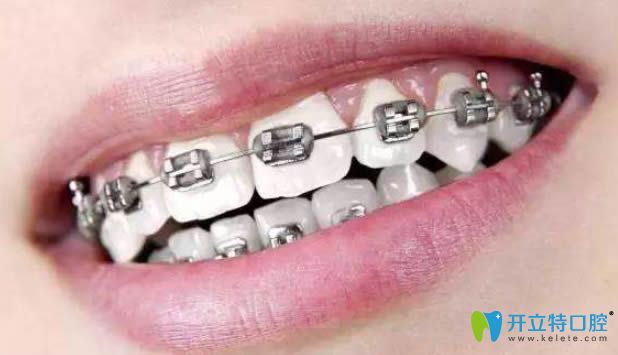 金屬托槽矯正器圖片