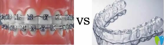 金屬牙套和隱形牙套哪個(gè)好