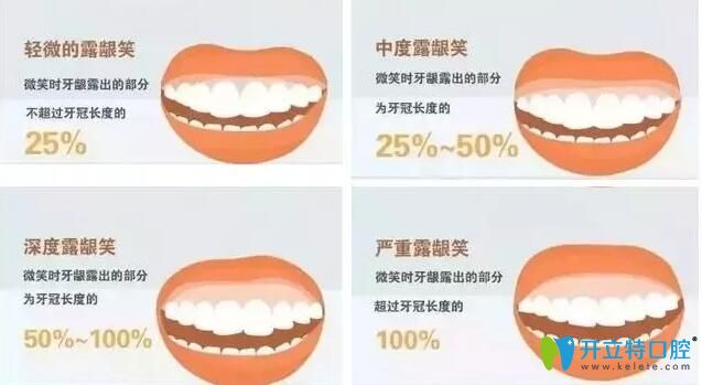 孩子笑露牙齦長大會好嗎要整牙嗎