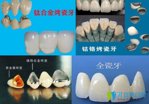 談各種常見烤瓷牙的優(yōu)缺點及價格
