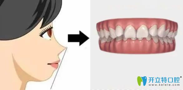 深覆合矯正多少錢(qián)?請(qǐng)看天包地牙齒矯正價(jià)格表