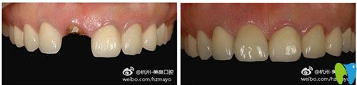 美奧口腔種植牙前后對(duì)比圖