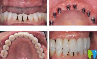 寧波牙博士口腔郝義身醫(yī)生全口種植牙案例
