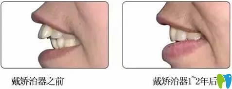 成人齙牙選擇隱形牙套矯正后的對(duì)比效果