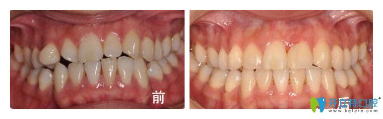 諾德齒科曹雪怎么樣？真人案例效果來(lái)證明實(shí)力