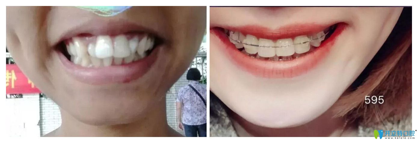 深圳諾德口腔牙齒矯正怎么樣？齙牙矯正案例效果公布