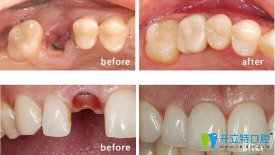 諾德齒科怎么樣？文梁種植牙案例效果驗證