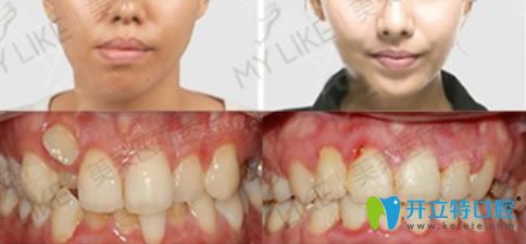 30歲顧客牙齒擁擠+畸形牙矯正案例對比圖