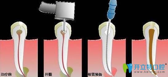 不清楚根管治療和拔牙哪個(gè)好看兩者區(qū)別