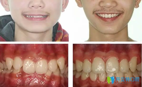 重慶維樂(lè)牙科深覆合矯正后下巴變化對(duì)比圖