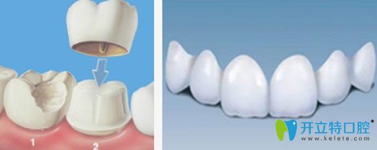 牙齒美容冠是什么及多少錢一顆？
