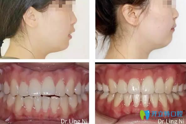 重慶維樂(lè)口腔深覆蓋矯正前后臉型效果圖