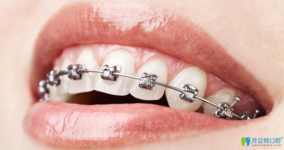 老姐問我唇側和舌側矯正哪個好&價格是多少