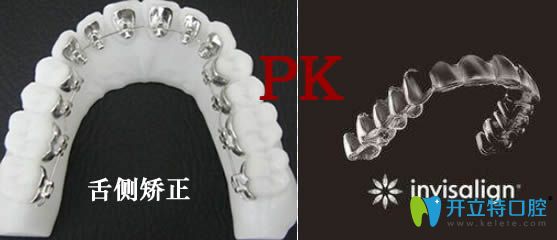 隱適美矯正和舌側矯正哪個好