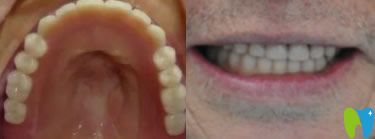 老爸在寧波牙博士口腔做半口種植牙后 老爸在寧波牙博士口腔做半口種植牙后