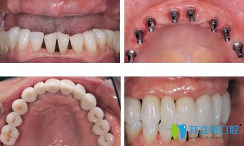 沈陽(yáng)歡樂(lè)口腔李金剛怎么樣？李主任半口種植牙著真人案例來(lái)證明