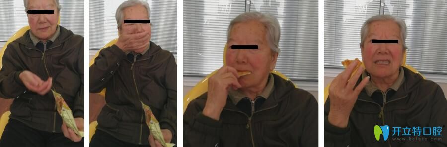 那彤全口義齒修復(fù)病例