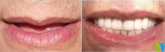 西安諾貝爾口腔李江院長(zhǎng)60歲老人全口種植牙前后對(duì)比<span style=