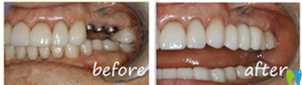 吉林愛齒口腔種植牙前后對(duì)比圖