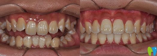 廣州圣貝口腔武玉海隱形矯正案例