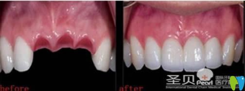 成都圣貝30歲顧客門(mén)牙缺失種植前后對(duì)比效果