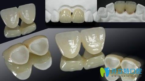 臨時牙冠多少錢