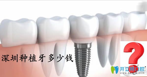 公布深圳種植牙價格表及當地正規(guī)的十大種植牙醫(yī)院排名