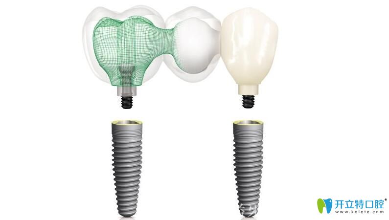 瑞典諾貝爾NobelGuide種植系統(tǒng)