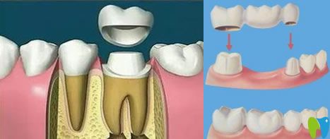 臨時(shí)牙冠能戴多久,掉了怎么辦？