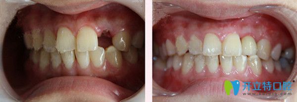 單顆即刻種植技術前后效果圖
