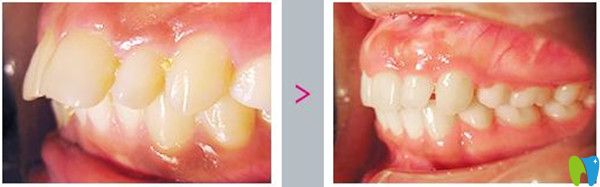 牙齒美容冠矯正前后療效圖
