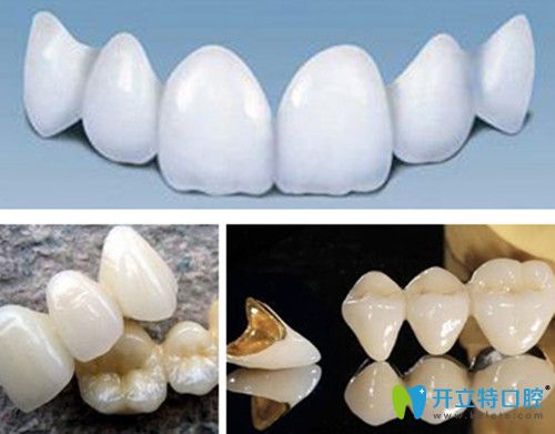 美容冠矯正使用的材料