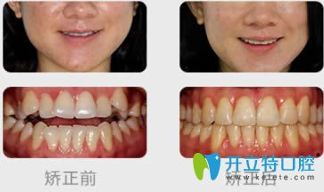 南京博韻口腔沈春梅青少年牙齒開(kāi)合矯正前后對(duì)比照