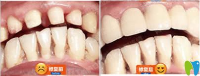 何靜全科醫(yī)生烤瓷牙修復(fù)前后對比效果