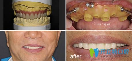 60歲的張先生做完全口種植牙后的效果 60歲的張先生做完全口種植牙后的效果