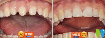 何靜醫(yī)生美容冠修復(fù)前后對比效果