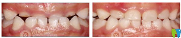兒童牙齒矯正前后效果圖
