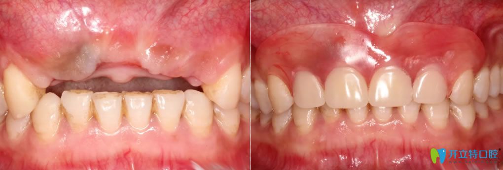 西安中諾蘇醫(yī)生上頜牙多顆缺失修復(fù)前后對比照