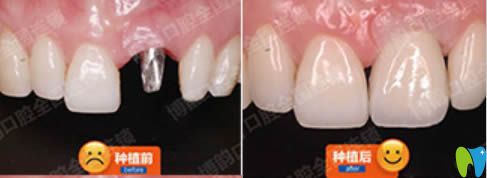 南京博韻何靜單顆牙缺失種植牙對比效果