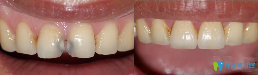 西安中諾蘇雪梅前門牙齒修復(fù)前后對比效果