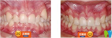 南京博韻口腔青少年虎牙+深覆合矯正前后對比效果 南京博韻口腔青少年虎牙+深覆合矯正前后對比效果