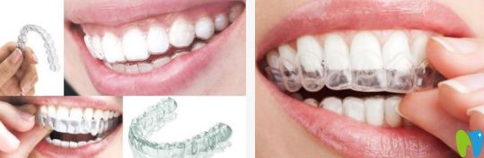 隱形矯正器