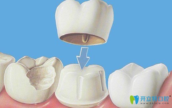 牙齒美容冠矯正技術