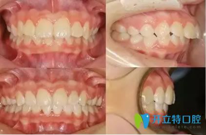 西安中諾口腔孫麗35歲顧客齙牙矯正案例及前后對比效果