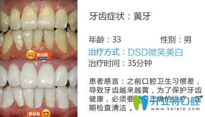 南京博韻口腔茹雪醫(yī)生牙齒美白效果