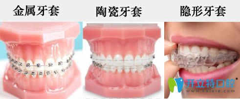 公布牙套價(jià)格表(包含金屬托槽/半隱形陶瓷矯正/隱形矯正)