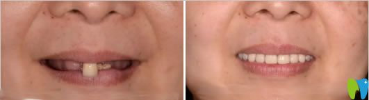 西安中諾劉世恒醫(yī)生立得用種植牙前后對比效果