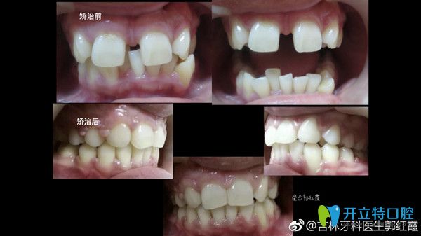 牙齒縫隙過大矯正前后對比圖